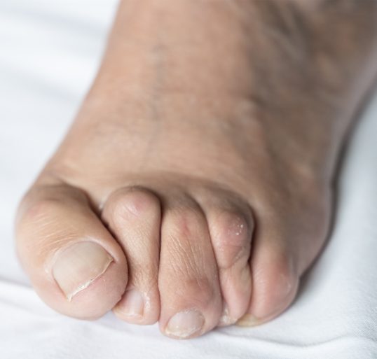 Symptome von Krallen- oder Hammerzehen - Orthopädie in Düsseldorf