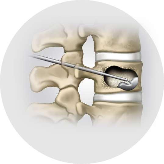 Vertebroplastie & Kyphoplastie - Schritt 4 - Orthopädie in Düsseldorf