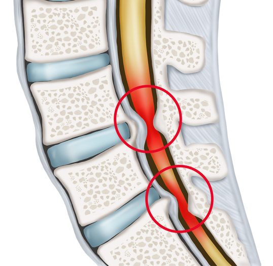 Symptome einer Spinalkanalstenose - Orthopädie in Düsseldorf