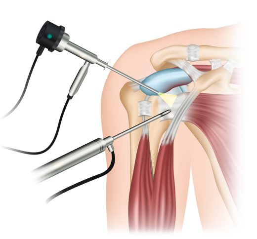 Arthroskopie der Schulter - Schulterarthroskopie | Schulter-Operation - Orthopädie in Düsseldorf