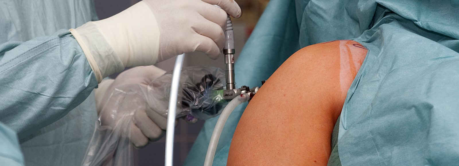 Schulterarthroskopie | Schulter-Operation | Schulter-Op in Düsseldorf