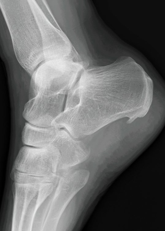 Ursachen des Fersensporns: Der Einfluss orthopädischer Expertise in Düsseldorf