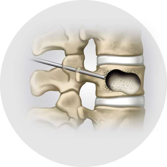 Vertebroplastie & Kyphoplastie - Schritt 3 - Orthopädie in Düsseldorf