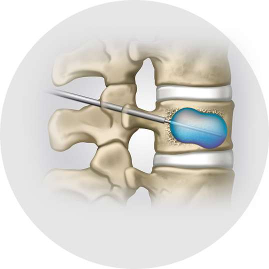 Vertebroplastie & Kyphoplastie - Schritt 2 - Orthopädie in Düsseldorf