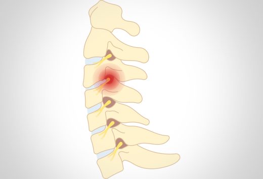 Behandlung des Facettensyndroms und anderer Wirbelsäulenprobleme - Orthopädie in Düsseldorf
