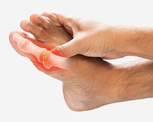 Behandlung von Hallux rigidus in Düsseldorf - Orthopädie in Düsseldorf