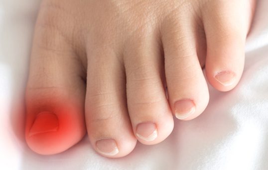 Symptome bei einem eingewachsenen Zehnagel - Orthopädie in Düsseldorf