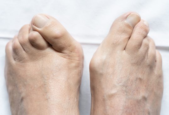 Ursachen für Krallen- bzw. Hammerzehen - Orthopädie in Düsseldorf