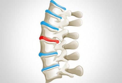 Linderung von Ischiasbeschwerden - Orthopädie in Düsseldorf