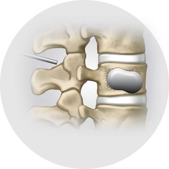 Vertebroplastie & Kyphoplastie - Schritt 5 - Orthopädie in Düsseldorf