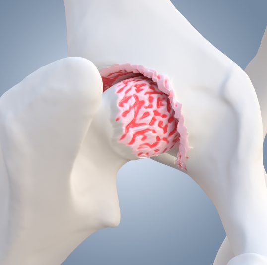 Die Ursachen einer Coxarthrose - Orthopädie in Düsseldorf