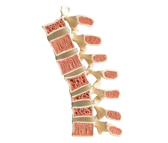 Die Behandlung von osteoporotische Wirbelbrüchen - Orthopädie in Düsseldorf