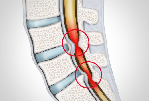 Spinalkanalstenose: Spezialbehandlung bei Einengungen des Wirbelkanals in Düsseldorf