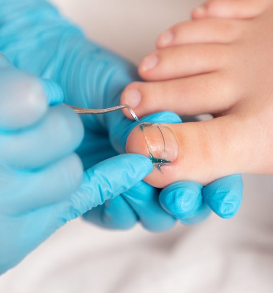 Ursachen von eingewachsenen Nägeln - Orthopädie in Düsseldorf