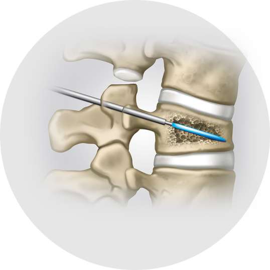 Vertebroplastie & Kyphoplastie - Schritt 1 - Orthopädie in Düsseldorf