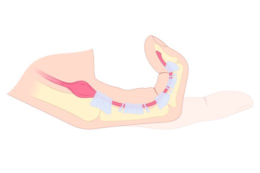 Symptome des schnellen Fingers - Behandlung - Orthopädie in Düsseldorf